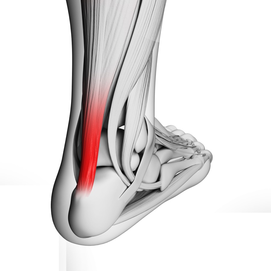 Acupuncture for Achilles Tendonitis