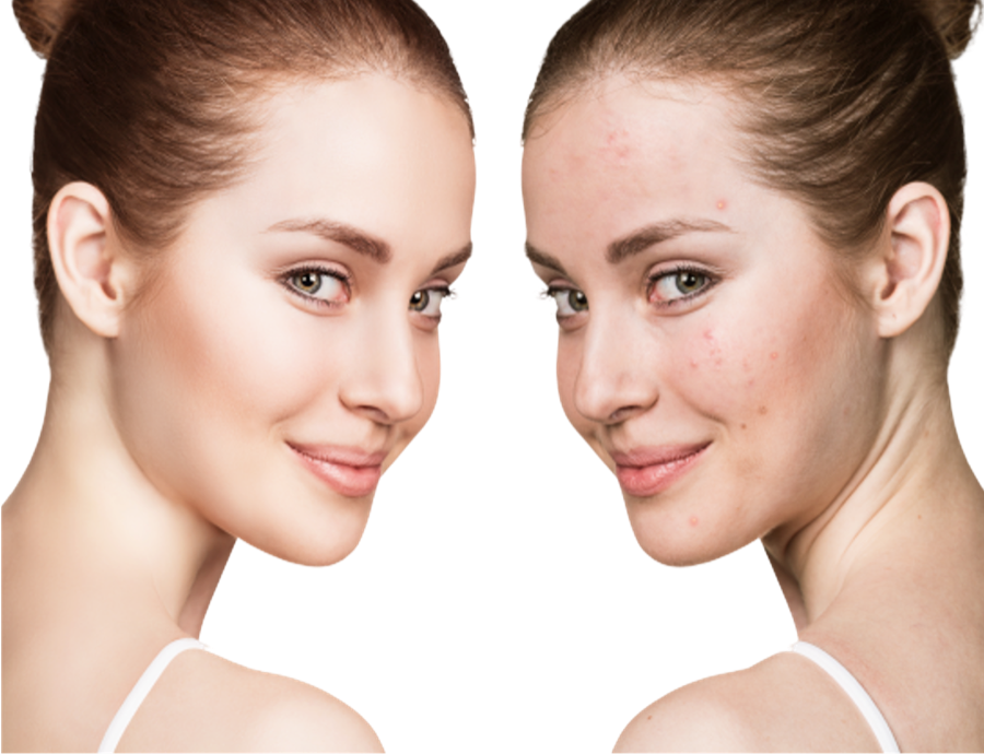 Acupuncture for Acne