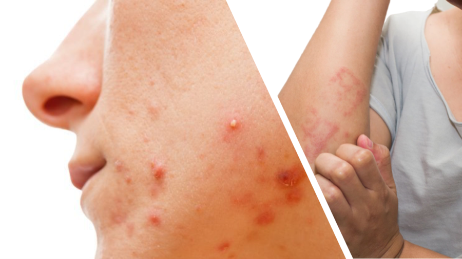 Acupuncture for Eczema: A Holistic Approach to Skin Health
